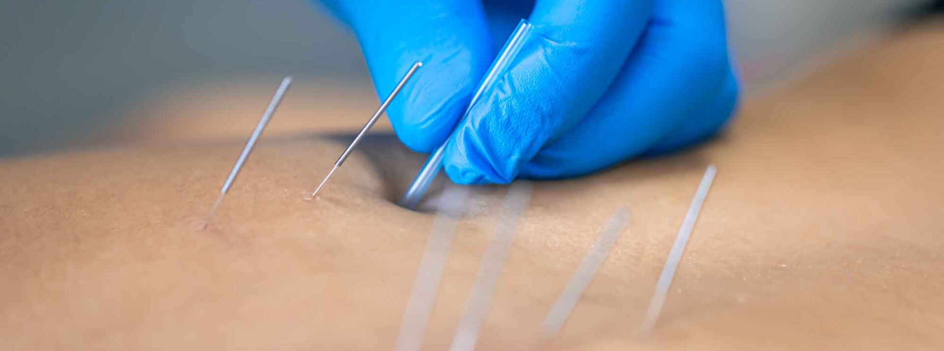 Dry Needling for Back Pain: Relieving Deep Muscle Stiffness