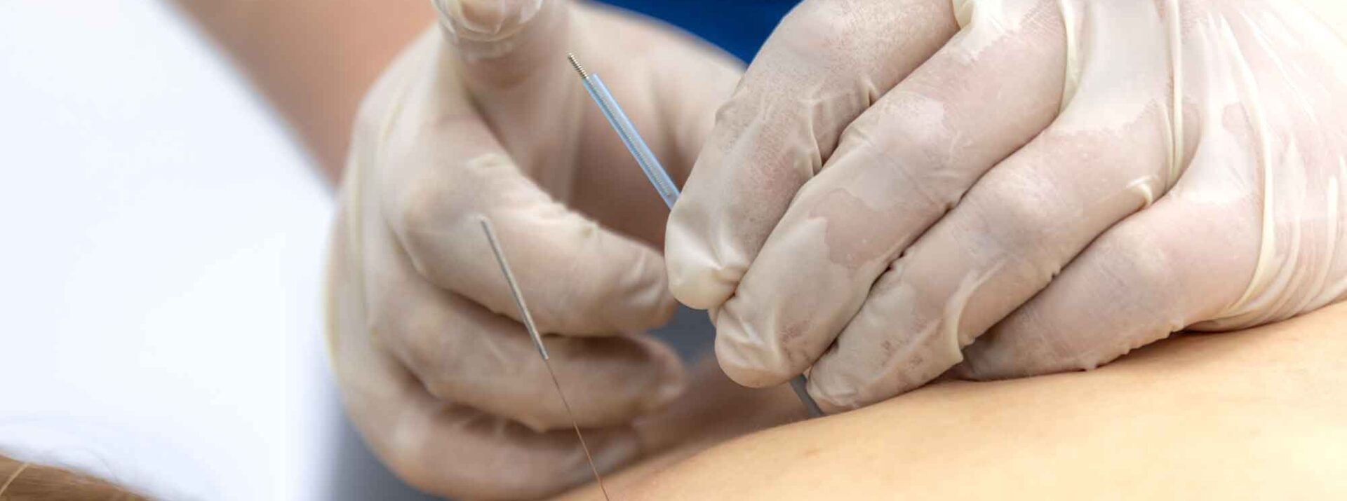 Trigger Point Dry Needling: Understanding the Science of Relief